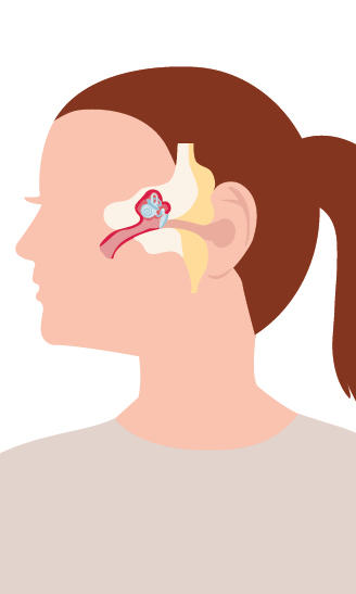 Grafik Mittelohrentzündung