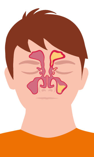 Grafik Entzündung der Nasennebenhöhlen