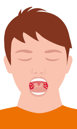 Grafik Gaumenmandeln